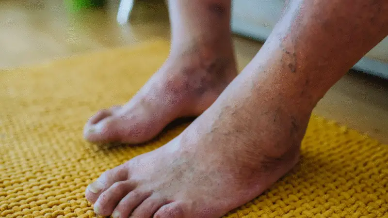 Dermopatia diabética: 8 sinais clássicos na pele