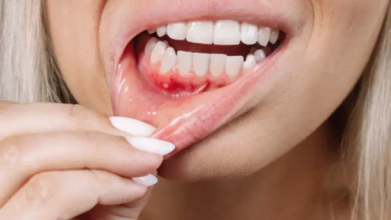 Periodontite e diabetes: 5 passos para cuidar e prevenir