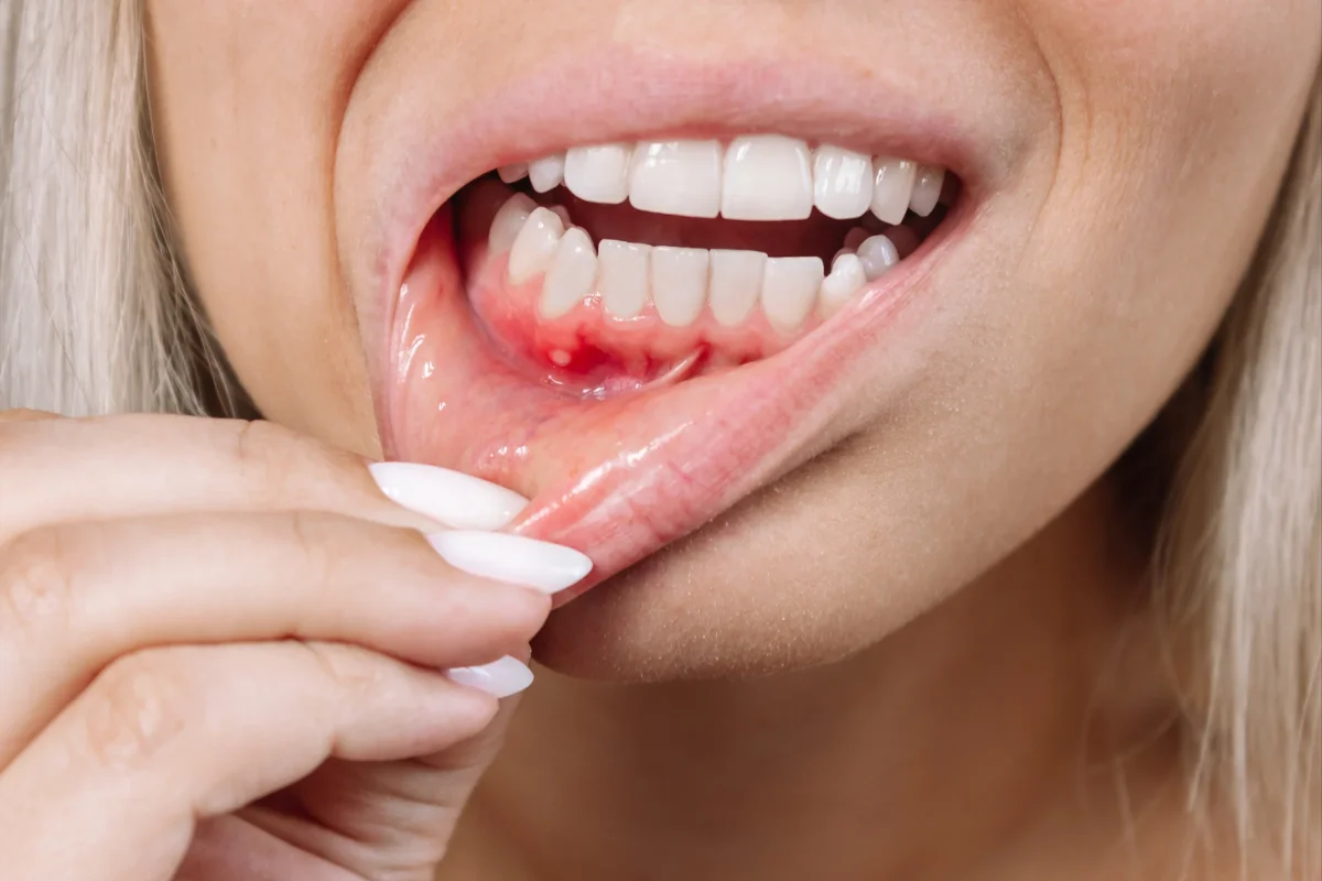 Periodontite e diabetes: 5 passos para cuidar e prevenir